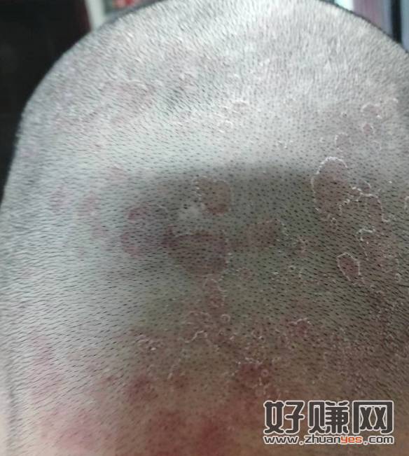 刚理完发，求助头皮上这是啥【有图慎入】